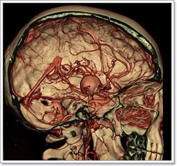 Beyin Damarlarında Kireçlenme Belirtileri ve Tedavisi