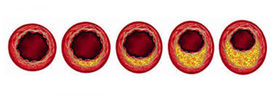 Damar Kireçlenmesi Belirtileri ve Tedavisi
