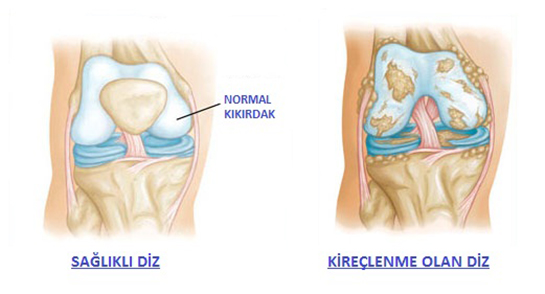 Dizde Kirelenme